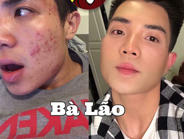 Công dụng Trị Mụn Bà Lão