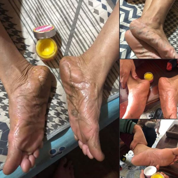 Á sừng, nứt nẻ toác da vac đau ngứa lâu năm chưa tìm được thuốc chữa